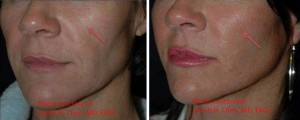 chen_b-a1 Actual results of Mid Face Rejuvenation by Dr. Achih Chen