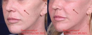chen_b-a2 Mid Face Rejuvenation by Dr. Achih Chen