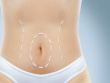 abdomen plastic surgery