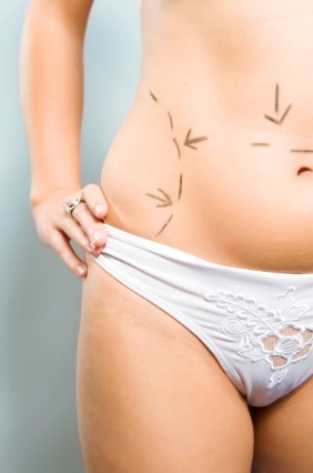liposuction-pictures
