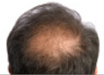 hair-loss