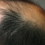 hair_transplant