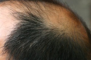 hair_transplant hair_transplant