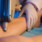 spider vein removal